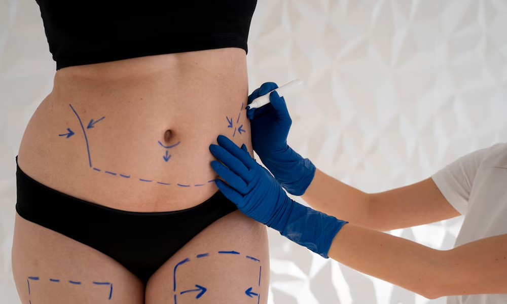 Karın Germe – Abdominoplasti Ameliyatı